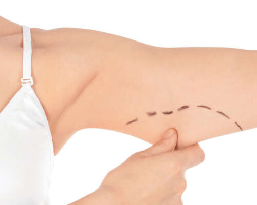 Woman with marks on arm for cosmetic surgery operation against white background, closeup