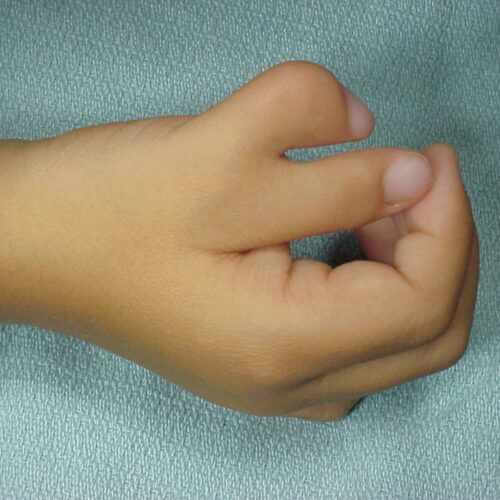 Dr. Ranjit Bhosle - Best Plastic Surgeon | Gynecomastia | Cyst Removal | Lipoma | Breast Surgery | Liposuction Expert.Dr. Ranjit Bhosale - Best Plastic Surgeon | Gynecomastia | Liposuction Expert| Cyst Removal Lipoma | Hair, Transplant. Ghatkopar West, , Borivali East, Mumbai, Maharashtra,Maroshi Rd Andheri.