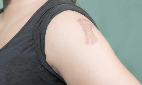 Dr. Ranjit Bhosle - Best Plastic Surgeon | Gynecomastia | Cyst Removal | Lipoma | Breast Surgery | Liposuction Expert.Dr. Ranjit Bhosale - Best Plastic Surgeon | Gynecomastia | Liposuction Expert| Cyst Removal Lipoma | Hair, Transplant. Ghatkopar West, , Borivali East, Mumbai, Maharashtra,Maroshi Rd Andheri.