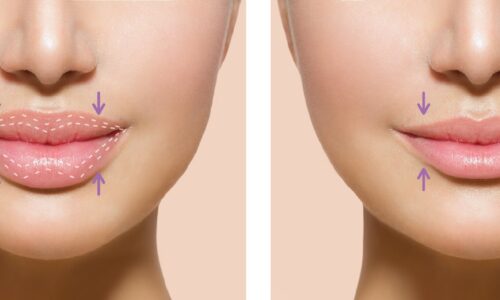 Lip reduction Dr. Ranjit Bhosle - Best Plastic Surgeon | Gynecomastia | Cyst Removal | Lipoma | Breast Surgery | Liposuction Expert.Dr. Ranjit Bhosale - Best Plastic Surgeon | Gynecomastia | Liposuction Expert| Cyst Removal Lipoma | Hair, Transplant. Ghatkopar West, , Borivali East, Mumbai, Maharashtra,Maroshi Rd Andheri.