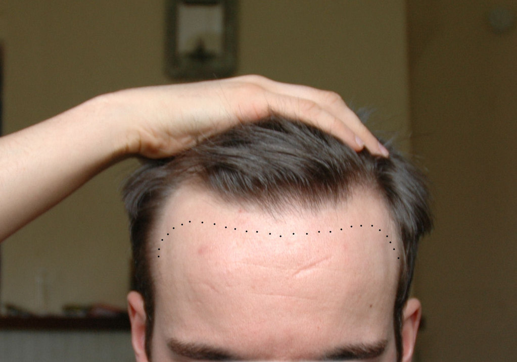 Dr. Ranjit Bhosle - Best Plastic Surgeon | Gynecomastia | Cyst Removal | Lipoma | Breast Surgery | Liposuction Expert.Dr. Ranjit Bhosale - Best Plastic Surgeon | Gynecomastia | Liposuction Expert| Cyst Removal Lipoma | Hair, Transplant. Ghatkopar West, , Borivali East, Mumbai, Maharashtra,Maroshi Rd Andheri.