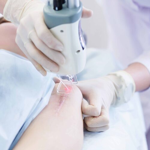 Scar-Revision Dr. Ranjit Bhosle - Best Plastic Surgeon | Gynecomastia | Cyst Removal | Lipoma | Breast Surgery | Liposuction Expert.Dr. Ranjit Bhosale - Best Plastic Surgeon | Gynecomastia | Liposuction Expert| Cyst Removal Lipoma | Hair, Transplant. Ghatkopar West, , Borivali East, Mumbai, Maharashtra,Maroshi Rd Andheri.