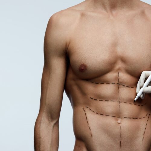 Six pack itching Dr. Ranjit Bhosle - Best Plastic Surgeon | Gynecomastia | Cyst Removal | Lipoma | Breast Surgery | Liposuction Expert.Dr. Ranjit Bhosale - Best Plastic Surgeon | Gynecomastia | Liposuction Expert| Cyst Removal Lipoma | Hair, Transplant. Ghatkopar West, , Borivali East, Mumbai, Maharashtra,Maroshi Rd Andheri.