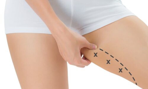 Dr. Ranjit Bhosle - Best Plastic Surgeon | Gynecomastia | Cyst Removal | Lipoma | Breast Surgery | Liposuction Expert.Dr. Ranjit Bhosale - Best Plastic Surgeon | Gynecomastia | Liposuction Expert| Cyst Removal Lipoma | Hair, Transplant. Ghatkopar West, , Borivali East, Mumbai, Maharashtra,Maroshi Rd Andheri.