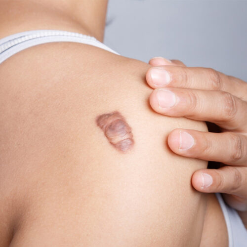 Dr. Ranjit Bhosle - Best Plastic Surgeon | Gynecomastia | Cyst Removal | Lipoma | Breast Surgery | Liposuction Expert.Dr. Ranjit Bhosale - Best Plastic Surgeon | Gynecomastia | Liposuction Expert| Cyst Removal Lipoma | Hair, Transplant. Ghatkopar West, , Borivali East, Mumbai, Maharashtra,Maroshi Rd Andheri.