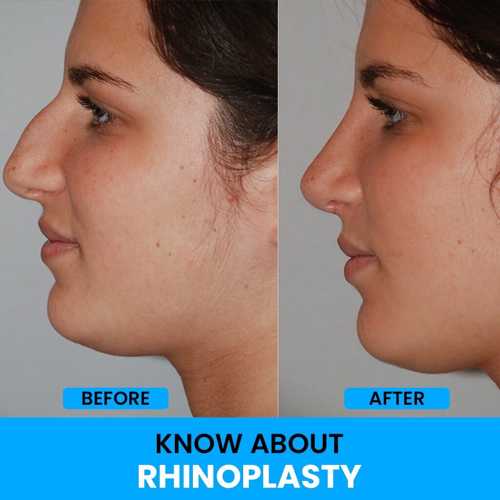 Dr. Ranjit Bhosle - Best Plastic Surgeon | Gynecomastia | Cyst Removal | Lipoma | Breast Surgery | Liposuction Expert.Dr. Ranjit Bhosale - Best Plastic Surgeon | Gynecomastia | Liposuction Expert| Cyst Removal Lipoma | Hair, Transplant. Ghatkopar West, , Borivali East, Mumbai, Maharashtra,Maroshi Rd Andheri.